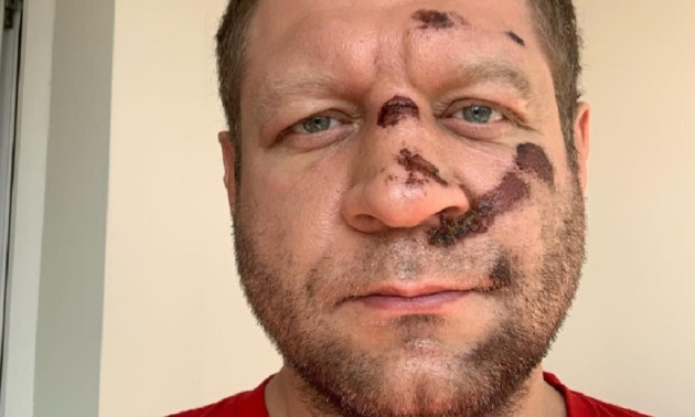 Легендарний росіянин розбився на велосипеді