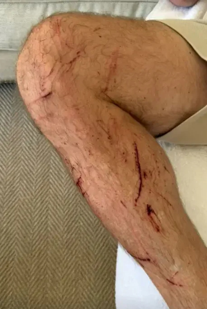 Ширер получил травмы после аварии