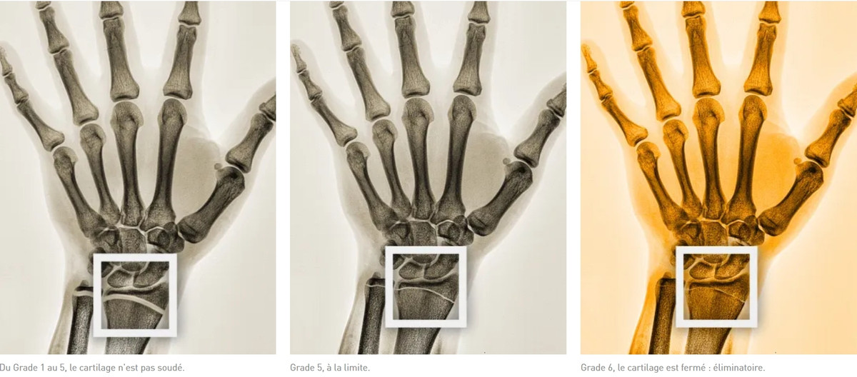 Зап'ястя дитини (ліворуч), підлітка (по центру) та дорослого (праворуч), lequipe.fr