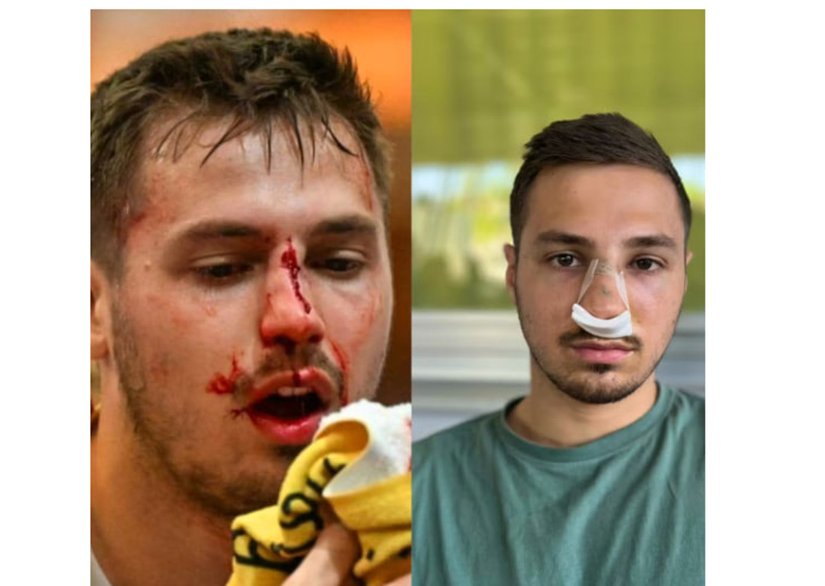 Маркус Мар (відразу після травми)/Маркус Мар (після хірургічного втручання)